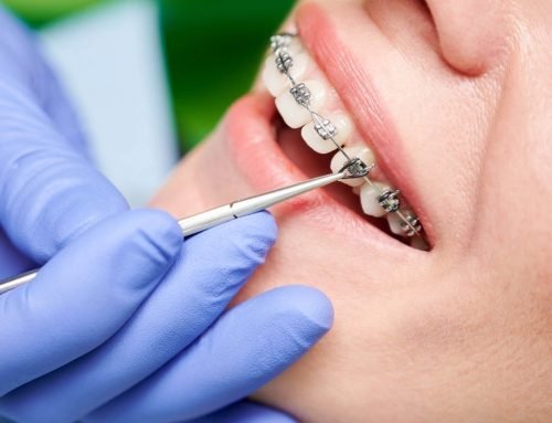 Opciones para Alinear Tus Dientes